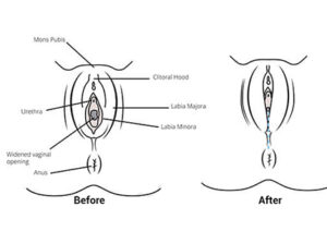 Hymen repair
