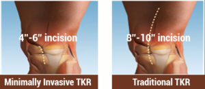 Knee Replacement in India