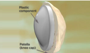 Knee Replacement in India