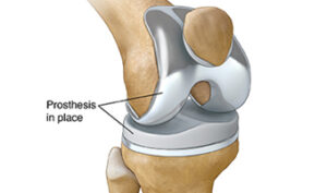 Knee Replacement in India