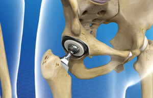 Total Hip Replacement Procedure