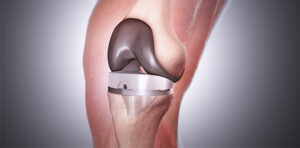 Total Knee Replacement