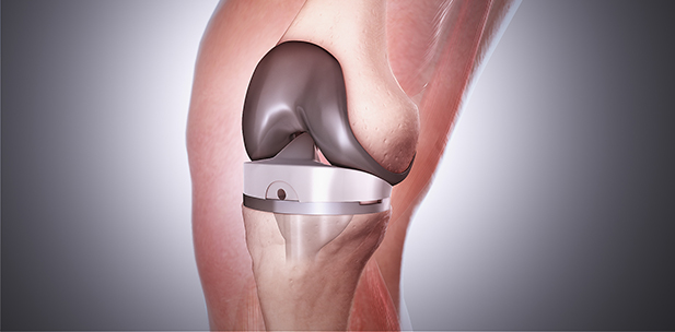 Knee Replacement in India