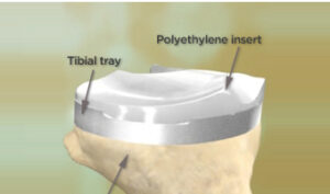 Knee replacement in India
