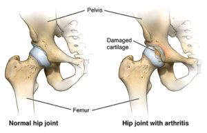 Total Hip Replacement