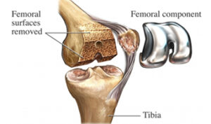 Knee Replacement in India