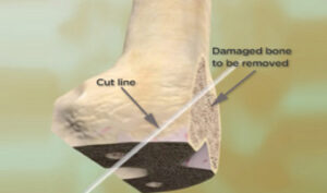 joint replacement in India