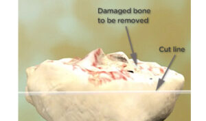best joint replacement in India