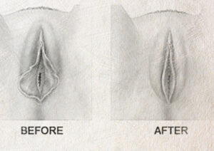 Vaginal Tightening Surgery