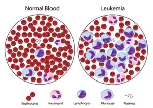 Blood Cancer Treatment