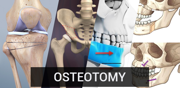 osteotomy
