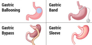 Weight loss surgery procedures