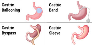 Weight loss surgery procedures