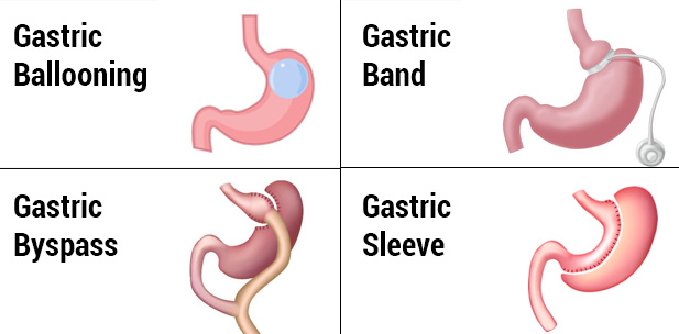 Myths and Facts about Bariatric Surgery ! 5 Weight loss surgery procedures