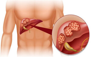 Liver cancer