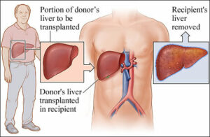 Liver Transplant Procedure