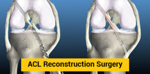 ACL repair in India