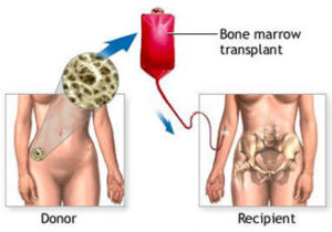 Bone marrow transplant for sickle cell disease