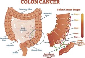 colon cancer Stages