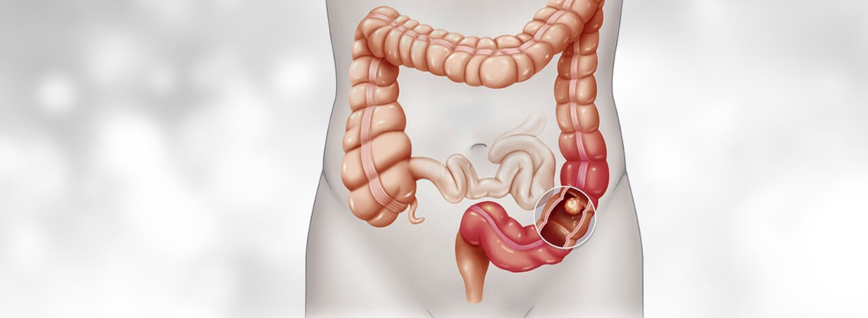 colon cancer treatment in india