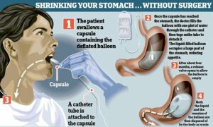 gastric ballon