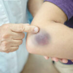 Liver damage warning signs - Frequent Bruising and Bleeding