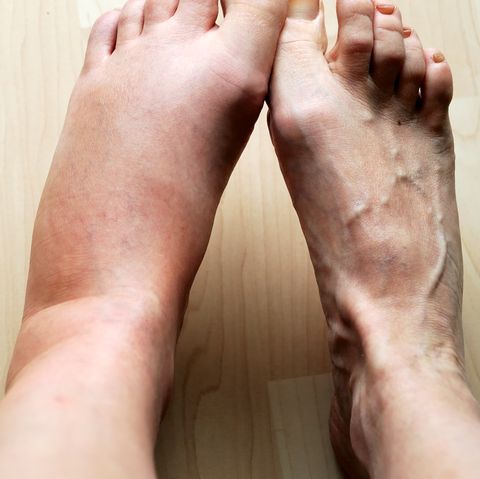 Liver damage warning signs - Swelling of feet