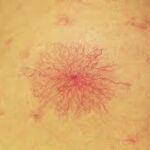 liver-diseases-warning-signs-Spider-Angiomas