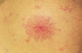 liver-diseases-warning-signs-Spider-Angiomas