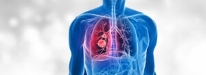 Advanced Treatments for Lung Cancer at Affordable Cost