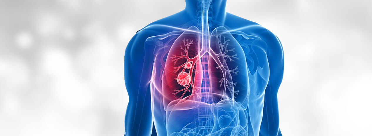 Advanced Treatments for Lung Cancer at Affordable Cost