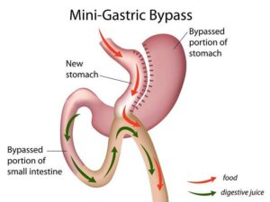 mini gastric bypass surgery