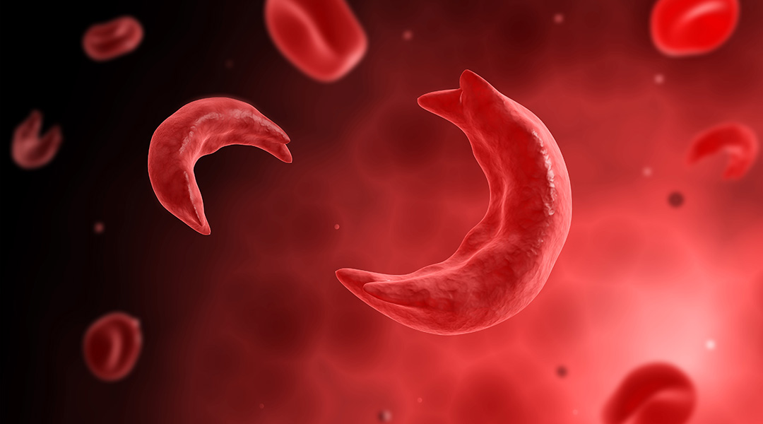 sickle cells causing anemia disease