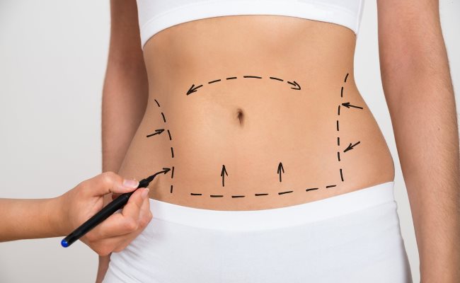 Tummy-Tuck-myths