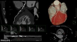 Computed Tomography Angiography