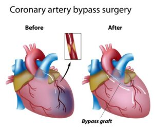 Bypass Surgery