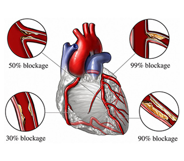 coronary angiogram