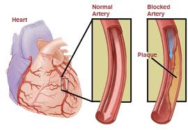 Stable Angina