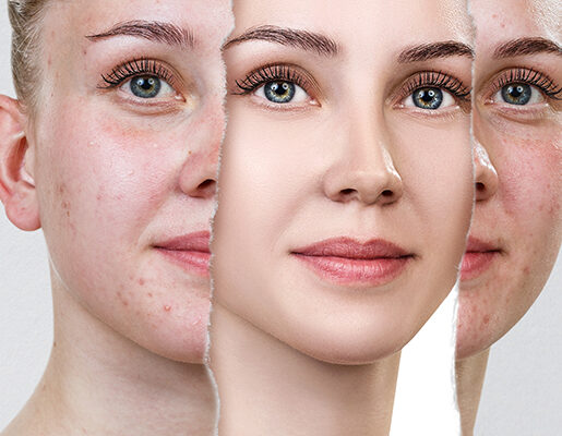 Acne-and-Pimple-Scars Acne-and-Pimple-Scars