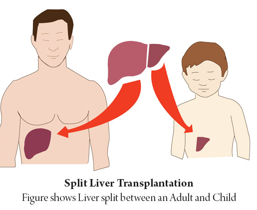 liver transplant in india, best liver transplant in india