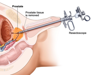 prostate cancer treatment in India