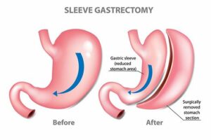 Gastric-Sleeve