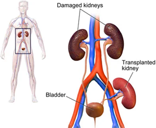 How to choose the best hospitals for kidney transplants in India