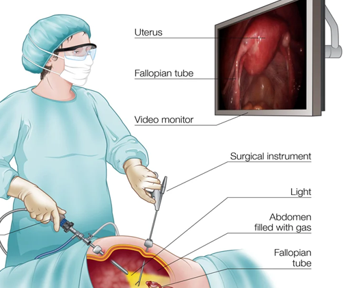 Laparoscopic surgery in Nigeria, fibroid surgery cost in nigeria