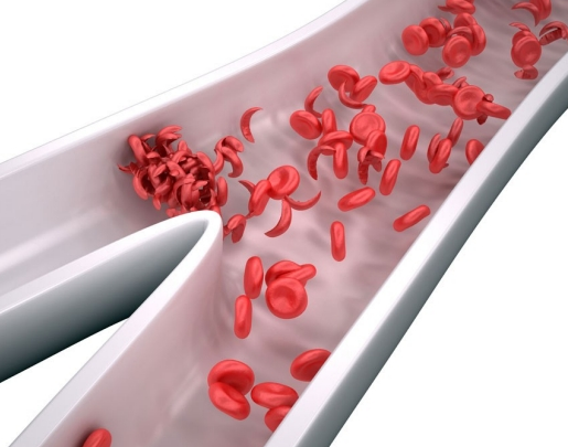 What is Sickle cell anemia