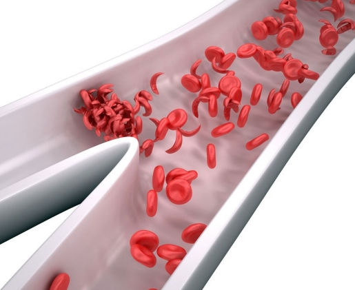 Sickle-cell-anemia-causes Sickle-cell-anemia-causes