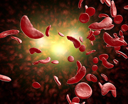 Sickle cell anemia treatment in India