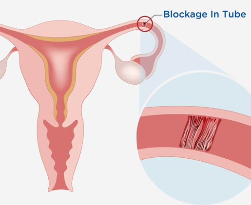 blocked fallopian tube treatment