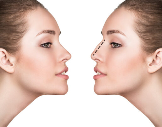 benefits-of-rhinoplasty rhinoplasty in India
