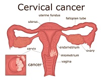 cancer treatment in India | MedicoExperts